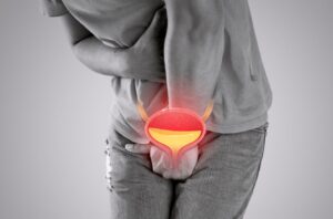 A retenção urinária é um problema que pode acontecer com homens e mulheres de forma aguda ou crônica. Precisa ser investigada porque pode se transformar em um caso de urgência médica e até ser indício de outros problemas de saúde. Leia esse texto até o final para entender o que é retenção urinária, sintomas e as formas de tratamento. O que é e o que causa retenção urinária? A bexiga funciona como um local de armazenamento de urina, que é o resultado líquido da filtragem do sangue pelos rins. A retenção urinária pode ser definida como uma condição que não permite que uma pessoa esvazie completamente a bexiga ao urinar ou até mesmo que a urina não possa ser eliminada. As causas da retenção urinária podem estar relacionadas a problemas neurológicos na bexiga, uso de certos medicamentos, uma obstrução que está impedindo a saída da urina ou até mesmo provocada por infecções do trato urinário. No entanto, pode ocorrer também de maneira pontual, após uma cirurgia, como uma retenção urinária após cesárea ou após uma cirurgia para tratamento de hérnia, quando o paciente não consegue urinar, mas logo após volta à condição normal. Esse problema urológico pode ocorrer de forma crônica ou aguda e atinge mais os homens a partir dos 50 anos: Retenção urinária crônica Os pacientes conseguem urinar, mas sentem que a bexiga não ficou completamente vazia. Em muitos casos, logo sentem novamente a necessidade de urinar, mas ainda assim não sai todo o líquido. Esse resíduo de urina fica dentro da bexiga pode trazer complicações futuras porque prolonga o tempo em contato com substâncias tóxicas que deveriam ser eliminadas na urina, e o volume residual após a micção tende a ficar cada vez maior. A retenção urinária em idosos costuma ocorrer na forma crônica, e atinge mais os homens. Em geral, estão ligadas às doenças relacionadas à próstata, como por exemplo, a hiperplasia prostática que favorece a retenção urinária. Retenção urinária aguda Pode ser bastante perigosa, porque a pessoa sente que tem urina, mas não consegue eliminar. Assim, a bexiga continua a se expandir, e pode prejudicar a drenagem da urina proveniente dos rins, levando em alguns casos a insuficiência renal aguda. É uma condição que ocorre subitamente. Quais os sintomas da retenção urinária? Quando o paciente tem a versão aguda da retenção urinária, o principal sintoma é a vontade de urinar seguida pela incapacidade de eliminar o líquido, mas também surge uma dor aguda e desconforto na parte inferior do abdômen. É bastante perigoso e exige uma ida urgente ao pronto atendimento. Na forma crônica, os pacientes podem perceber: Sentem vontade de urinar mais de 8 vezes ao dia, e ainda assim todas as vezes notam uma urgência; Pode haver escapes durante o dia; Mesmo com a sensação de urgência, há uma demora antes que a urina saia de fato; Sensação de pressão abdominal; O fluxo de urina é irregular, em alguns casos, é fraco ou há gotejamentos; Acordar mais vezes à noite para urinar (noctúria), etc. Leia mais: Dor nos rins Pedra nos rins sintomas Obstruções que bloqueiam fluxo de urina A retenção urinária por obstruções ocorre quando algo bloqueia a saída da urina, por exemplo, hiperplasia prostática (aumento da próstata), estenose de uretra (estreitamento uretral), coágulo de sangue ou um tumor. Em homens, infecções e inflamações como uretrites, prostatites e balanites também podem causar retenção urinária, além de cistite (inflamação da bexiga), que também pode acometer as mulheres. Além disso, nos homens, como já citado, o aumento benigno da próstata, a hiperplasia, assim como o câncer de próstata, também são motivos de obstrução que pode levar à retenção da urina. Nas mulheres, os prolapsos genitais também podem ser uma causa da retenção. Medicamentos que causam retenção urinária Alguns medicamentos podem resultar retenção urinária devido à fraqueza muscular ou sintomas que vão afetar o esfíncter interno, que fica no ponto de encontro da bexiga e da uretra. Podem ser alguns relaxantes musculares, anti-inflamatórios não esteroides, antidepressivos, antipsicóticos, anfetaminas, remédios para incontinência urinária, etc. Danos nos nervos Quando há uma ruptura ou danos nos nervos que estão relacionados com o trato urinário, pode ocorrer uma retenção urinária, porque prejudica o envio dos sinais do cérebro de volta à bexiga. Podem ocorrer devido esclerose múltipla, Mal de Parkinson, partos vaginais, complicações de diabetes, acidente vascular encefálico, lesões no cérebro, procedimentos cirúrgicos abdominais ou de coluna. Retenção urinária: tratamento Quando a retenção urinária ocorre de forma aguda, é necessário um atendimento de urgência para providenciar a liberação da passagem da urina, antes que ocorra prejuízo à função renal. O mais provável é que o médico opte por um procedimento para drenar a urina, fazendo o canal urinário ser desobstruído com ajuda de um cateter. Caso não seja possível, também é possível tentar drenar a urina por meio de um cateter suprapúbico, que será inserido na pele acima da bexiga. Já quando a retenção é crônica, o tratamento pode ser a longo prazo. Em primeiro lugar, o médico irá pedir exame para medir a quantidade de urina após a micção. Além disso, também será necessário drenar a urina remanescente, para isso, em alguns casos, será necessário o uso de um cateter. O próximo passo é identificar a causa da retenção. Se decorre de uma obstrução urinária ou se está relacionada à perda da capacidade da bexiga em ''bombear" a urina (hipoatividade da bexiga). Esta avaliação é feita por meio de um estudo urodinâmico. O urologista também pode prescrever alguns medicamentos, como antibióticos, em casos de infecção. Para a próstata aumentada, há medicamentos para retenção urinária para ajudar a glândula a relaxar e reduzir o tamanho. Outra abordagem médica pode ser a terapia comportamental, que envolve a ingestão de líquidos em horários determinados e exercícios para o assoalho pélvico para controlar melhor os esfíncteres urinários. O importante é não ignorar os sintomas da retenção urinária, porque tanto nos casos agudos como nos crônicos podem causar danos à saúde.