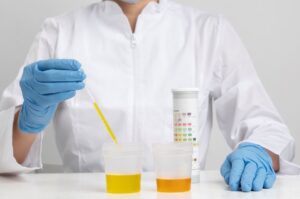 Quando uma pessoa olha o resultado laboratorial e verifica que apresentou hemácias na urina, o que significa isso? Vamos entender neste texto o que acontece quando as hemácias são detectadas em um exame de urina. O que significa hemácias na urina? Também conhecidas como glóbulos vermelhos ou eritrócitos, as hemácias são células sanguíneas, a presença delas na urina é conhecida como hematúria. A hemácia está entre os principais componentes do sangue, portanto, se o exame apresenta a hematúria, muito provavelmente, há um local de sangramento em algum dos órgãos do sistema urinário ou o rim não está filtrando corretamente o sangue e as hemácias estão escapando. Quando um médico prescreve um pedido de exame de urina, geralmente, é porque o paciente manifestou alguns outros sintomas, como: dor nos rins, urina com alteração na coloração e turva, náuseas, vômitos ou até febre. O normal é que a urina seja clara, amarelada e cristalina. Em muitos casos, a olho nu, a urina parece normal, apenas um exame laboratorial vai conseguir detectar a presença do sangue, quando é assim, se trata de hematúria microscópica. Já em outras situações, a alteração na cor da urina é visível, e a substância pode se apresentar na cor rosada, avermelhada ou cor de chá. Então, é denominada de hematúria macroscópica, que é quando existe uma grande quantidade de células sanguíneas na urina. O valor considerado normal para a presença de hemácias na urina é de 10.000 por mL ou 3 a 5 hemácias por campo. Quando estão dentro dessa faixa, o resultado pode ser hemácias raras na urina ou ausentes. Esses valores podem se alterar um pouco a depender dos valores de referência de cada laboratório. Quais são as causas das hemácias na urina? Em boa parte das vezes, as hemácias altas na urina não querem dizer que o paciente está com uma doença grave, porque até mesmo exercícios pesados podem estimular o sangue na urina, que desaparece rapidamente; e até o uso de certos medicamentos pode causar o sintoma, como os anticoagulantes. Por isso, é importante que na consulta o paciente apresente todo o histórico prévio ao médico, como o estilo de vida e medicações que costuma ingerir cotidianamente. Já em outras situações, a presença de hemácias na urina pode ser o sinal de patologias, como: Infecção ou doença renal, como a pielonefrite aguda; Infecção no trato urinário; Lesão nos rins; Pedra no rim; Próstata aumentada (hiperplasia prostática benigna); Câncer de bexiga ou rim. Por exemplo, quando há hemácias na urina na gravidez é porque a mulher pode estar com uma infecção urinária, que precisa ser tratada, porque pode gerar riscos para a gestação. Além disso, condições crônicas também podem causar hemácias na urina, como: anemia falciforme, hemofilia, hepatite viral e doença renal policística. Outro fator, seria uma predisposição genética para que a pessoa seja propensa ao sangramento urinário. Em alguns casos, dependendo dos outros sinais e sintomas, o médico pode solicitar testes adicionais, como um exame de sangue com uma contagem completa de células sanguíneas, que ajudam a entender melhor o funcionamento renal. Os testes de imagem também podem ajudar a refinar o diagnóstico. Como é realizado o tratamento para hemácias na urina? Além de analisar os hábitos de vida e outras condições clínicas do paciente, como ser tabagista, obeso ou diabético, o médico irá avaliar também os outros resultados do teste de urina que pode apontar a presença de hemoglobina, glóbulos brancos (leucócitos) e hemácias na urina. O tratamento para cada situação que levou à hematúria vai depender da causa. Se o sangue na urina estiver relacionado às infecções, muito provavelmente, o médico irá prescrever antibióticos para combater os micro-organismos que invadiram o órgão. Já na hematúria que é causada pelo deslocamento de pedras nos rins, os medicamentos podem ser indicados, porém, de acordo com o tamanho desses cálculos pode ser necessária uma cirurgia. Caso as hemácias na urina sejam fruto de uma glomerulonefrite mais avançada, que é uma inflamação não infecciosa dos rins e prejudica a filtragem do sangue, o tratamento pode envolver um acompanhamento constante e ingestão de anti-inflamatórios e imunossupressores. Mas se for um caso de próstata aumentada, a medicação será bastante efetiva, mas em alguns também pode ser necessário um procedimento cirúrgico. Conclusão Com hemácias presente na urina, é necessário uma avaliação do médico a partir de uma anamnese detalhada e a associação com outros exames para chegar a uma melhor abordagem terapêutica. Mas não é um sintoma que deve ser ignorado, independentemente das causas, esse sinal de sangue na urina precisa ser avaliado com cuidado. Em muitos casos, apenas um acompanhamento médico por um tempo será suficiente para entender se o sintoma desapareceu, já em outros, é necessária uma prescrição médica mais efetiva, para que a condição não evolua para quadros mais graves.
