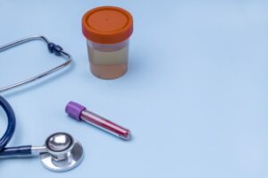 Quando um paciente percebe sangue na urina, vai precisar buscar uma ajuda médica, para identificar os motivos desse sinal. Quer saber por quê? Leia esse texto até o final para entender mais sobre esse tema. Sangue na urina: o que pode ser? A urina costuma ter um tom amarelado, mais ou menos claro, dependendo da quantidade de líquidos ingeridos e até do que é composta a alimentação. Mas, às vezes, uma pessoa pode identificar a urina com uma tonalidade bem diferente e se assustar. Será que é perigoso ter sangue na urina? Para o sangue na urina, o termo técnico médico correto é hematúria. Esse sinal pode ser detectado diretamente pelo paciente durante a micção, mas , às vezes, a perda de sangue é bastante discreta e só será identificada nos resultados de exames. Esse sangue pode ter sido originado em qualquer parte do trato urinário, desde a uretra a bexiga, ureteres e rins. Os vestígios de sangue na urina, geralmente, estão relacionados a problemas no trato urinário ou pedra no rim, mas pode ter também outras explicações. Em alguns casos, a urina se apresenta mais alaranjada, avermelhada ou até mesmo amarronzada. Identificar essa característica também é importante para que o médico inicie uma linha de análise para chegar ao diagnóstico e entender o que pode ser o sangue na urina, porque em alguns casos, esse tom da urina nem sempre vai indicar presença de sangue. Normalmente, algumas situações que causam o tom avermelhado na urina não estão relacionadas a patologias: Menstruação: se uma mulher está menstruada, há a possibilidade do fluxo se misturar à urina e conferir o tom avermelhado; Alimentação: o consumo de alimentos avermelhados, que contém corantes, ou até beterraba, associada à baixa hidratação; Remédios: certos remédios anticoagulantes podem provocar traços de sangue na urina; Esforço físico: quando as pessoas praticam atividades físicas muito intensas, como correr maratonas, podem apresentar sangue na urina nas primeiras 24 horas após o exercício. Alguns problemas de saúde podem ser mais simples ou até mais graves, por isso, é tão importante buscar uma ajuda médica o quanto antes. Leia mais sobre: Dor nos rins O que causa sangue na urina? Além das situações mencionadas acima, algumas patologias também podem motivar a presença de sangue na urina: Cistite Essa é uma infecção por micro-organismo que está limitada à bexiga, mas também é conhecida por infecção urinária. É um problema que atinge muito mais as mulheres. Além de sentir ardência, dor e aumento na frequência miccional, a cistite também pode provocar sangue na urina. Além da bexiga, essa infecção pode atingir todo o trato urinário. Câncer na bexiga O sangue na urina pode ser o primeiro sinal de câncer na bexiga, mas nem sempre será perceptível a olho nu, apenas detectado em exames. Nos estágios iniciais, o sangramento é pequeno e pode não haver dor. Mas com o tempo, podem surgir outros sintomas além de aumento no sangramento, como dor lombar e queimação ao urinar, urgência miccional, fluxo fraco, maior frequência urinária, perda de apetite e de peso, inchaço nos pés e fraqueza. Doenças renais O sangue na urina pode ser problema nos rins, como um cálculo renal, que é uma substância mineral dentro dos rins e provoca muita dor. Além desse problema, outra patologia mais perigosa que atinge os rins e que tem o sangue na urina como um dos seus sintomas é a pielonefrite, que pode provocar danos às funções renais. Em ambos os casos, os sintomas podem ser sangue na urina e dor nas costas. Doença diverticular da bexiga O divertículo na bexiga é uma espécie de hérnia que se forma na mucosa do órgão. Pode estar associado a outras condições que também podem provocar sangue na urina, como infecção urinária, refluxo urinário, tumores na bexiga, etc. Problemas no fígado Quando o tom da urina é amarronzado ou em tons ainda mais escuros, pode ser um sinal de problemas sérios no fígado, como uma inflamação do fígado e hepatite. Esses são problemas graves que precisam ser investigados o quanto antes. Hiperplasia prostática benigna O sangue na urina masculina pode ser fruto de um aumento da próstata, conhecido como hiperplasia prostática benigna. Essa é uma condição que surge naturalmente com o avançar da idade, mas em alguns casos, esse aumento pode ser maior que o normal. Não se trata de um problema de malignidade, mas traz bastante incômodo aos homens porque aumenta muito a frequência urinária, promove uma dificuldade de esvaziar a bexiga e jato fraco de urina, além de estar associado à infecção urinária, que também é mais um motivo do surgimento do sangramento. Câncer de próstata O sangue na urina pode surgir em estágios mais avançados do câncer de próstata já que nos estágios iniciais não costuma apresentar sintomas. Além do sangramento, a doença mais avançada também vai provocar dor óssea na região das costas, dificuldade para urinar e sensação de não conseguir esvaziar completamente a bexiga. Quando sai sangue na urina, o que fazer? O primeiro passo é buscar uma ajuda médica, inicialmente, pode ser até um pronto-atendimento, especialmente se o sangramento for abundante e tiver coágulos de sangue na urina . Porém, depois dos exames realizados no hospital, é preciso buscar um especialista. A partir da sintomatologia que será apresentada pelo paciente na consulta, o urologista irá solicitar exames complementares para refinar o diagnóstico. Neste momento, mesmo tendo sido realizado um exame de urina no hospital, o médico vai solicitar novamente o teste, além de uma urocultura, pode também ser necessária uma biópsia. Alguns exames de imagem são importantes e ajudam a identificar a causa do surgimento da hematúria. Em alguns casos, o tratamento vai envolver uso de medicamentos, já em outros, como no caso de um cálculo renal, o paciente poderá ser encaminhado para uma ureterorrenoscopia, caso a pedra do rim não tenha sido eliminada. No caso de uma hiperplasia, podem ser prescritos medicamentos e procedimentos minimamente invasivos, já nos casos de câncer, a cirurgia para retirada do tumor também pode ser indicada. O mais importante é que o paciente não negligencie esse problema. O sangue na urina pode ter causas menos graves, porém, se forem problemas como um tumor, o tratamento precisa ser realizado o quanto antes, para aumentar as chances de cura.
