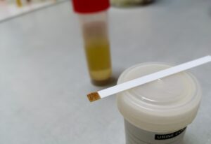 Quando uma pessoa percebe que está com a urina turva, deve buscar uma consulta médica, porque esse é um sinal de que algo pode não estar bem no seu organismo. Para entender o que significa urina turva e os problemas que estão associados a essa característica, leia esse texto até o final. O que é urina turva? A urina é resultado da filtragem do sangue e excesso de água pelos rins. Deve ter uma coloração amarelada, clara e cristalina, quando está turva e escurecida, pode ser indicativo de uma série de problemas. Geralmente, a urina turva é resultado de uma alta alcalinidade no sistema urinário, que pode ser resultado de uma cistite, pielonefrite ou pedra no rim. Porém, a alcalinidade da urina também pode ser fruto da dieta do paciente, se for composta apenas por vegetais e frutas, com ingestão limitada de grãos e carnes. Nos homens, o aspecto turvo na urina também pode denotar problemas na próstata e até mesmo uma ejaculação retrógrada. No entanto, em homens e mulheres, essa característica também pode ser um sinal de desidratação e até de infecções ou doenças sexualmente transmissíveis. A desidratação e corrimentos vaginais também podem deixar a urina turva na gravidez. Esse sintoma também pode ser um alerta para a pré-eclâmpsia, que é uma condição grave que causa hipertensão e pode colocar a gravidez em risco. É importante ter atenção a outros sintomas associados ao aspecto da urina, porque, durante uma consulta, as queixas dos pacientes poderão ajudar a orientar o médico sobre a linha de diagnóstico e o tratamento mais apropriado para cada condição. Para isso, o médico vai solicitar, primordialmente, um exame de urina, que pode revelar informações significativas sobre o que está ocorrendo no corpo. Conheça as principais causas de uma urina turva: Desidratação Quando uma pessoa não bebe líquidos nas quantidades necessárias, a urina fica mais concentrada, com um tom amarelo mais escuro e com aspecto turvo. A desidratação também pode deixar a urina com um certo odor de amônia. Se não está com nenhum sintoma adjacente e a urina estiver muito escurecida, experimente aumentar a ingestão de líquidos. Caso ela volte a ficar mais clara e cristalina, o problema pode ter sido apenas o déficit hídrico. Um risco importante é que não tomar líquidos na quantidade adequada sistematicamente pode levar à formação de pedra nos rins. Além disso, a desidratação também pode causar sintomas como desorientação, tonturas, desmaios, batimentos cardíacos acelerados e dificuldades para respirar. Infecção urinária A urina com cheiro forte e turva pode ser um sintoma de infecção urinária, uma proliferação de micro-organismos no trato urinário, que é composto pela bexiga, uretra e rins. Quando a infecção é na bexiga, é denominada de cistite; quando é na uretra é uretrite; e quando sobe para os rins é pielonefrite, que é uma condição mais grave e que pode afetar a funcionalidade renal. Quando a urina turva é fruto de uma infecção urinária, costuma vir acompanhada de ardência ou dor ao urinar e aumento da frequência miccional. Pedra nos rins O cálculo renal também causa urina turva e, em muitas vezes, também há presença de sangue. Isso ocorre devido ao deslocamento das pedras pelo rim. Além da urina turva e da hematúria, as pedras no rins provocam dores intensas na lombar ou na pelve, náuseas e vômitos e queimação ao urinar. É preciso um atendimento de urgência para o alívio da dor, que é muito forte, mas também porque de acordo com o tamanho da pedra pode ocorrer uma obstrução do canal urinário, provocar hidronefrose e levar o paciente a uma cirurgia. ISTs As infecções sexualmente transmissíveis, especialmente a clamídia e a gonorreia, podem resultar em uma urina turva e com cheiro forte e fétido. Além da urina alterada, essas doenças também podem vir acompanhadas de dor ou ardência ao urinar, dor durante a relação sexual, coceira na região genital, corrimentos e erupções cutâneas na região. Vulvovaginites As vulvovaginites são inflamações na vulva ou na vagina. Podem ser resultado de infecções por bactérias, vírus e fungos ou causada por alergias a substâncias químicas, como sabonetes e amaciantes. Além da urina turva, essas inflamações também trazem sintomas como dor ao urinar, coceiras, corrimentos e cheiro fétido na vagina após o sexo. Prostatites Inflamações na próstata também podem causar a urina com aspecto turvo, porque o processo inflamatório na glândula pode bloquear o fluxo urinário e acontecer o acúmulo de sangue e detritos no líquido retido. Além do aspecto da urina ligeiramente turvo, as prostatites também causam dor e queimação na micção, sangue na urina, dor ao ejacular, micção frequente, febre e calafrios. Ejaculação retrógrada Na ejaculação retrógrada, o sêmen não é eliminado pelo pênis, volta para a bexiga e o orgasmo é seco. Assim, quando o homem urina, o aspecto do líquido fica turvo, porque está misturado ao sêmen. Diabetes, esclerose múltipla e certos medicamentos podem estimular a ejaculação retrógrada. Doença renal diabética A urina turva pode ser efeito colateral de uma diabetes, uma doença que também apresenta sintomas como: excesso de sede, aumento da frequência urinária, dificuldades de cicatrização de feridas, etc. Caso a diabetes não seja tratada, também pode provocar insuficiência renal. Leia mais sobre: Dor nos rins Tratamento para urina turva O tratamento da urina turva vai depender da causa que levou a esse sintoma. As abordagens terapêuticas podem incluir: Infecções urinárias: antibióticos são a principal forma de tratamento, podem ser administrados, primeiramente, em um pronto-atendimento, por via intravenosa e, posteriormente, por via oral, quando o paciente já está em casa; Desidratação: o aumento da ingestão hídrica já pode melhorar o aspecto da urina, porém, caso seja uma desidratação grave, o paciente pode precisar de internação; DSTs: os antibióticos são a abordagem para tratar essa condição; Prostatites: em alguns casos de prostatites, pode não ser necessário nenhuma interação medicamentosa, já em outros, também podem ser administrados antibióticos; Diabetes: além de o paciente necessitar buscar ajuda especializada para manter as taxas de açúcar no sangue controladas, por meio de controle da alimentação, com ingestão oral de insulina ou via intravenosa, também pode necessitar de exames constantes de urina para acompanhar as condições dos rins. A urina turva pode não ter grandes consequências, em alguns casos, pode ser até inofensiva, porém, pode revelar condições preocupantes que exigem um acompanhamento médico. Caso perceba essa característica em sua urina, o primeiro cuidado a tomar é buscar ajuda de um urologista. Esse especialista vai investigar o quadro, indicar o tratamento adequado para cada caso, além de reforçar maneiras de evitar esse sinal do organismo, ao manter um estilo de vida equilibrado, que inclua uma boa ingestão de líquidos diariamente e a adoção de uma dieta saudável.