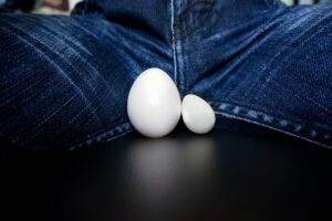 A hidrocele é um problema que costuma atingir mais os bebês recém-nascidos do sexo masculino, mas também pode ocorrer com homens na idade adulta e trazer alguns desconfortos. Neste texto, saiba mais sobre hidrocele, o que é, sintomas e possíveis tratamentos. O que é hidrocele? São várias as condições que podem afetar os órgãos sexuais masculinos, como a fimose, varicocele ou balanite. Além dessas condições, também está a hidrocele. A hidrocele testicular é caracterizada quando um fluido enche o escroto e o torna inchado. Não provoca grandes prejuízos à saúde, porém, traz alguns desconfortos. Pode ocorrer em um único testículo, deixando-o de tamanho diferente, denominada hidrocele unilateral, ou em ambos, o que é chamado de hidrocele bilateral. Embora não seja considerado algo grave, é necessária uma avaliação do pediatra, quando ocorre ainda bebê, ou do urologista, na idade adulta, para entender se o inchaço do escroto é mesmo uma hidrocele ou problemas mais graves, como um câncer. Além disso, a hidrocele pode estar associada a um ponto fraco na parede abdominal (hérnia inguinal), o que também exige tratamento. O que causa hidrocele? Tem sintomas? Cerca de 10% dos meninos nascem com hidrocele, que começa durante o desenvolvimento no útero. Isso ocorre porque quando os testículos descem para o escroto são acompanhados de um saco cada um, permitindo que um fluido envolva cada um deles, em geral, cada saco se fecha e o fluido é absorvido. Quando o saco não se fecha, ocorre o acúmulo de líquidos. A hidrocele testicular infantil pode desaparecer espontaneamente em algumas semanas. Já no caso de homens adultos ou mais velhos ocorre com 1% da população masculina e pode ser causada por 2 motivos: Um acúmulo de líquido ao redor do testículo devido a um problema de drenagem; Lesão do testículo por pancadas; Inflamação ou infecção, como epididimite e orquite. O principal sintoma da hidrocele é o inchaço testicular, porém, em alguns casos, os homens também podem sentir uma sensação de peso e desconforto na região. Em alguns casos, esses desconfortos podem ser piores pela manhã do que à noite. No entanto, se, após uma pancada, o homem sentir dor súbita e intensa no testículo, é preciso buscar ajuda imediata, porque, além da hidrocele, ele pode estar manifestando uma torção testicular, que exige tratamento em poucas horas, para não causar danos definitivos ao testículo. Isso ocorre porque a torção testicular impede o suprimento de sangue para o testículo. Mas, esse problema é mais raro de acontecer. Tipos de hidrocele Hidrocele comunicante: esse tipo tem contato com os fluidos da parede abdominal. É quando o saco ao redor do testículo não se fecha. Esse tipo de hidrocele costuma estar associada às hérnias inguinais, que são dolorosas. Nestes casos, o escroto parece bem maior, inchado e muda de tamanho ao longo do dia; Não comunicante: neste tipo, o saco se fechou, porém, o corpo não absorveu o fluido. Como é o diagnóstico da hidrocele? O diagnóstico da hidrocele começa com exames físicos, que podem incluir a verificação de protuberâncias na virilha, caroços e outras alterações na região íntima, além da checagem se há algum tipo de dor. O médico pode, também, usar luz para enxergar através do escroto e checar se há algum líquido na área. Em outro exame, o médico poderá pedir para o paciente tossir ou realizar uma pressão abdominal para verificar a existência de alguma hérnia inguinal. Para refinar o diagnóstico, o urologista pode solicitar um exame de imagem, com uma ultrassonografia. Tratamento da hidrocele Em muitos casos, não é necessário nenhum tratamento para a hidrocele, porque pode desaparecer espontaneamente em dias ou semanas. Essa cura espontânea normalmente ocorre quando é fruto de uma inflamação causada por trauma, ou até mesmo uma infecção não tratada. Alguns homens até utilizam um suporte para tornar mais tranquila a sensação de peso na região. No entanto, em outras situações, a hidrocele é grande, no caso de uma hérnia, e não some espontaneamente, então, pode ser necessária uma cirurgia para remoção do líquido acumulado. Além de visar aliviar os desconfortos, esse procedimento também pode ser indicado quando a hidrocele causa um comprometimento da irrigação de sangue para o testículo. Como é feita a cirurgia de hidrocele? A cirurgia de hidrocele é denominada hidrocelectomia e consiste na retirada do líquido dos testículos. Em algumas técnicas, prevê um pequeno corte no escroto ou na região abdominal para remover a hidrocele com ajuda de um aparelho com câmera na extremidade. De forma menos invasiva, o fluido também pode ser drenado com uma agulha longa e seringa. Essa técnica é mais utilizada em pacientes que têm risco cirúrgico. Mas, neste caso, a hidrocele pode voltar depois da cirurgia. Para evitar a recorrência, pode ser injetado um medicamento na região. Para realizar hidrocelectomia, é necessária anestesia, mas é um procedimento rápido que permite alta no mesmo dia ou no máximo no dia seguinte. Geralmente, após a cirurgia o paciente pode ter um pouco de dor e edema, que somem em poucos dias, mas para aliviar o desconforto, o cirurgião costuma prescrever medicação analgésica. Mas, apesar de simples, é preciso seguir algumas recomendações pós-operatórias para evitar complicações como as infecções. Entre as orientações, estão: Não andar de moto ou bicicleta por pelo menos 3 semanas; Evitar atividades extenuantes; Colocar bolsas de gelo no escroto no período da recuperação; Usar suportes; Repousar. Conclusão O urologista é o médico indicado para tratar patologias relacionadas ao aparelho urinário de homens e mulheres e ao sistema sexual masculino. Os homens não devem ter nenhum receio de buscar ajuda médica quando percebem qualquer alteração na região genital, porque, além de obter tratamento, também vão adquirir informações corretas. Portanto, quanto antes a população masculina adquirir essa consciência de cuidar mais da saúde, mais rápido pode começar a tratar os problemas de forma precoce, como a hidrocele, para evitar maiores complicações.